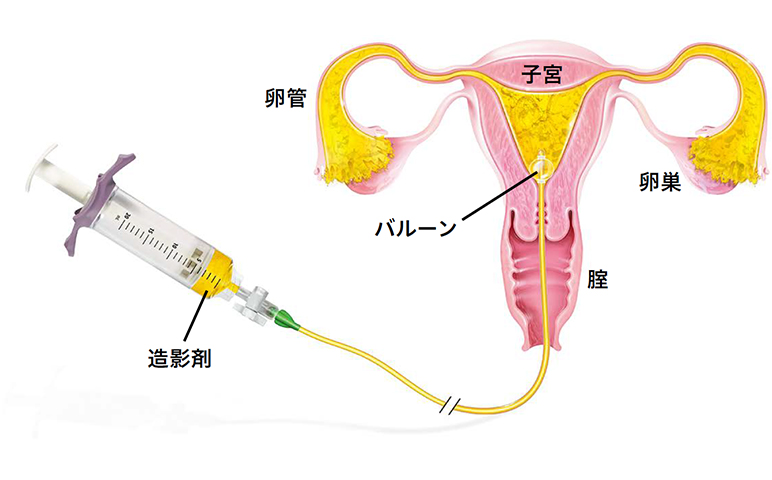 HSG Procedure 1 1 (1)